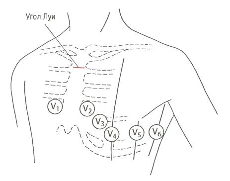 Схема наложения датчиков экг